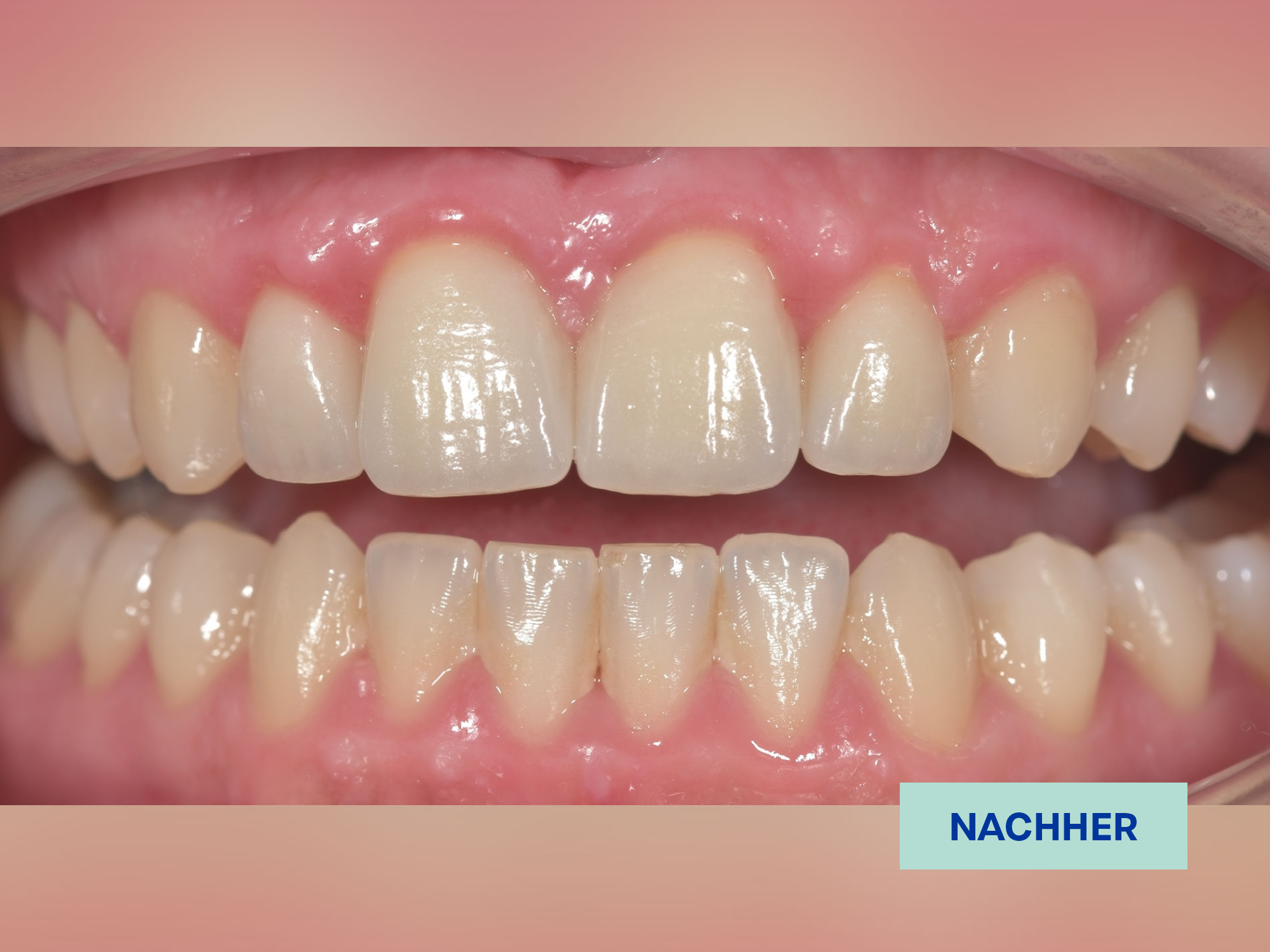 5.2.Zirkon_nachher