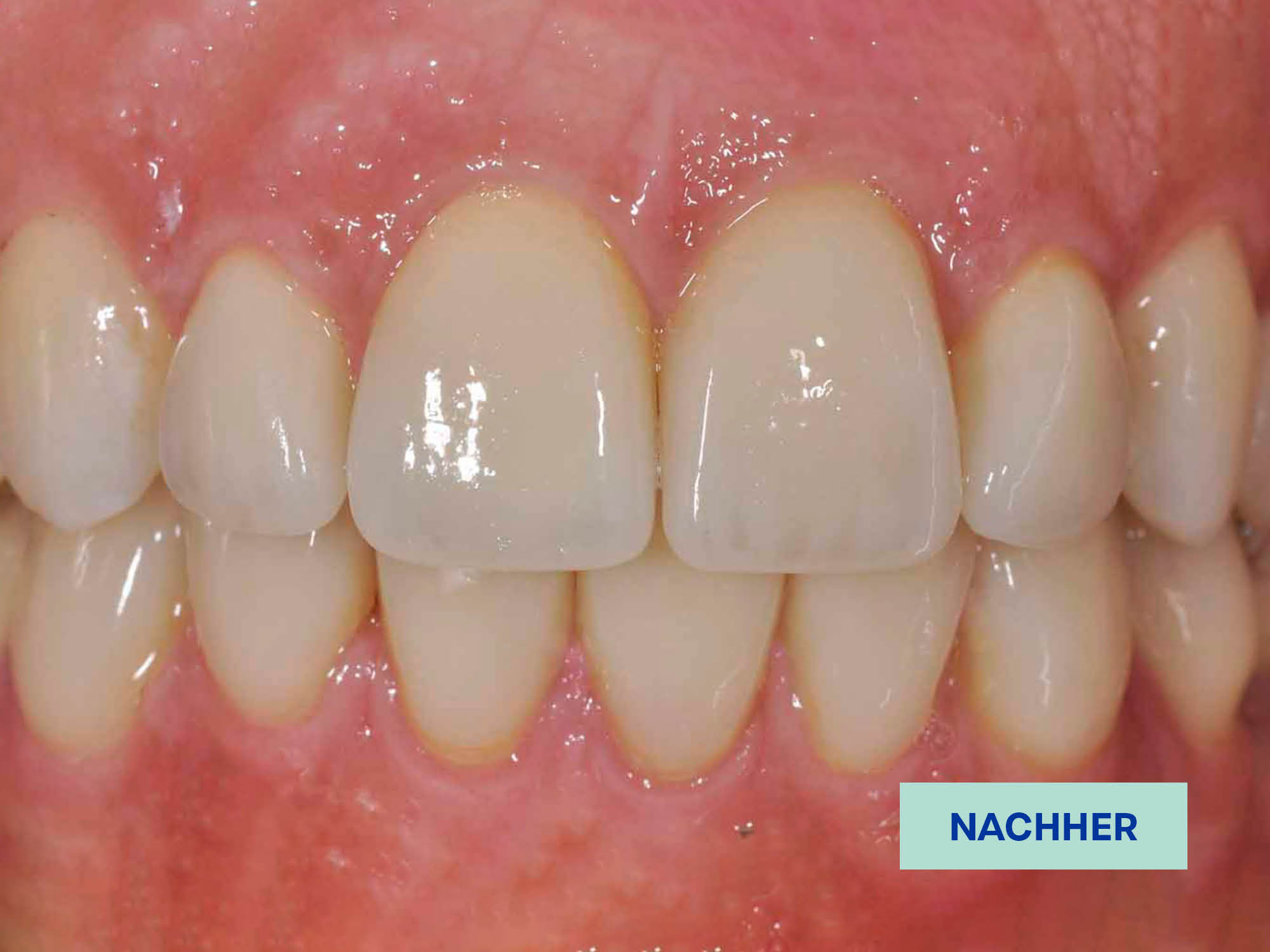 6.5_Zirkon_nachher